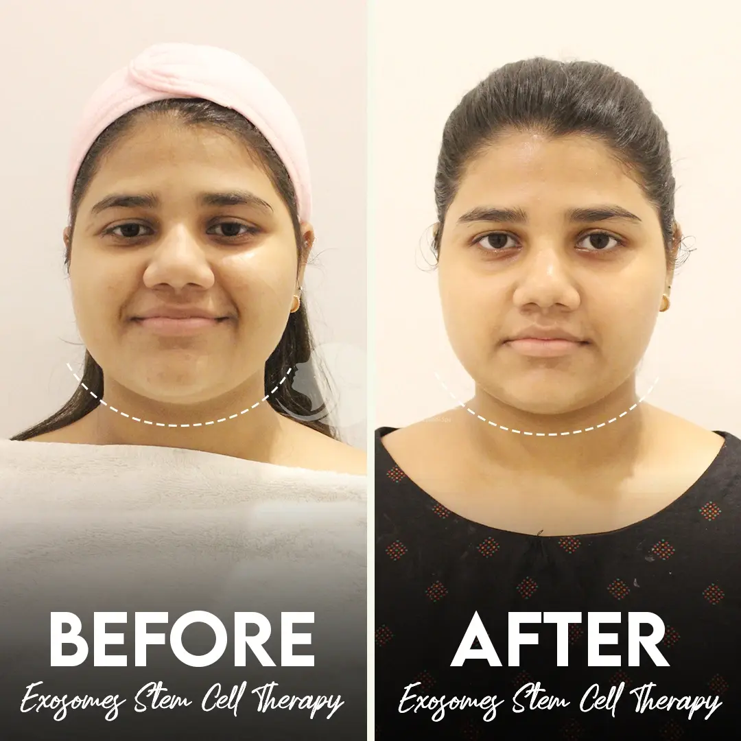 Before and after results of exosome therapy at Institute Cosmetique.